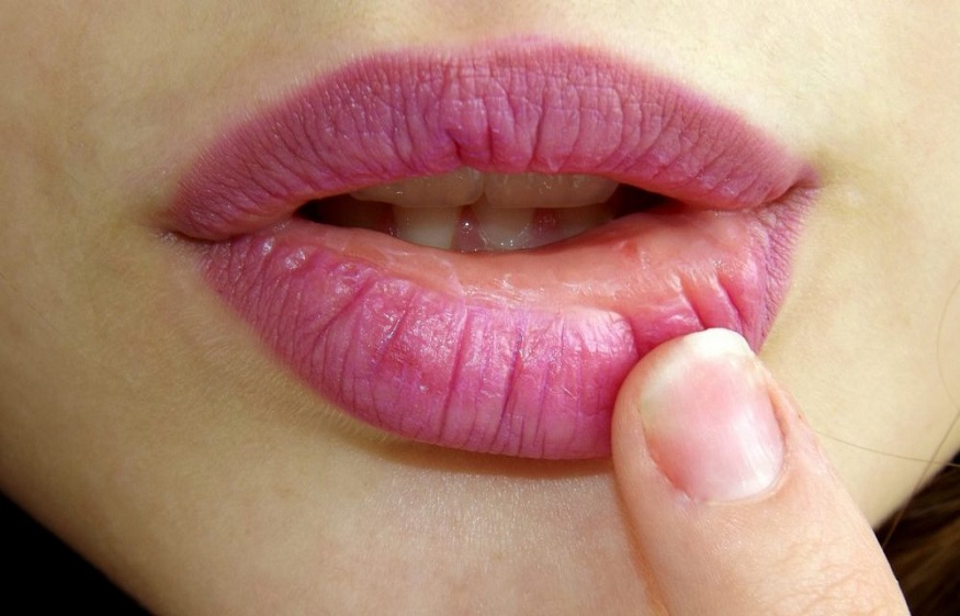 Angular cheilitis